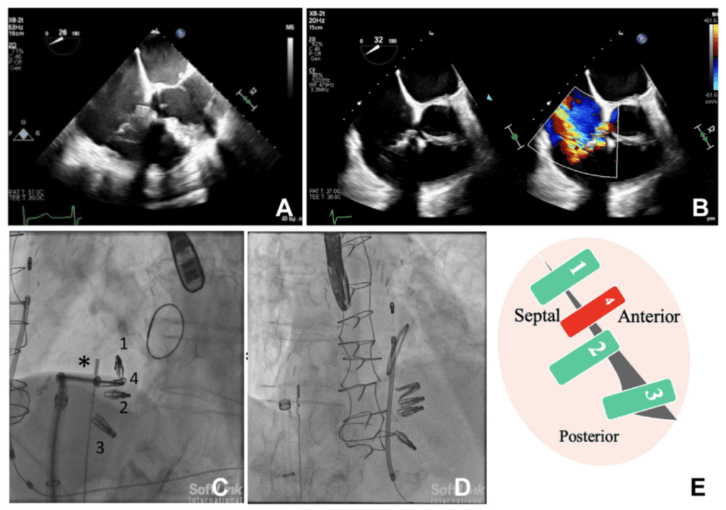 Fundamental Roles of Intracardiac Echocardiography and Fluoroscopy